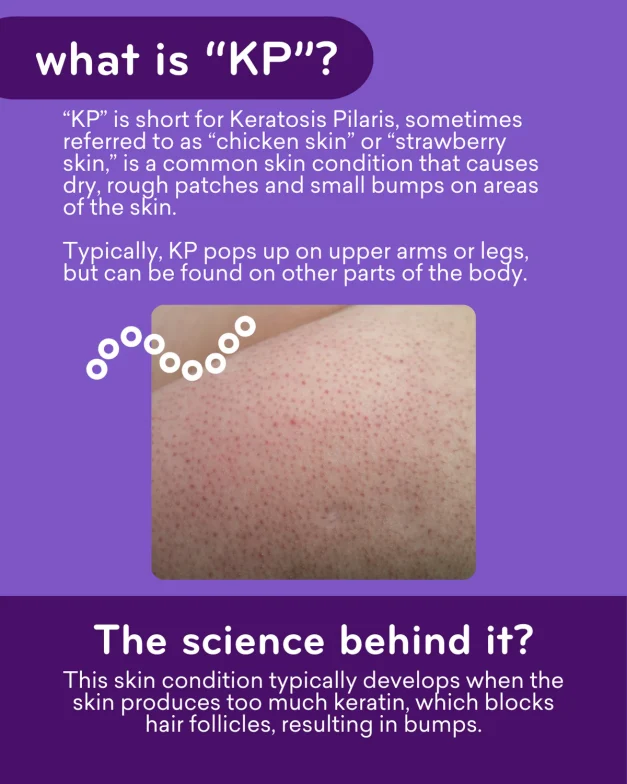 Amlactin KP Bumps Be Gone 15% Lactic Acid 85g - Image 3